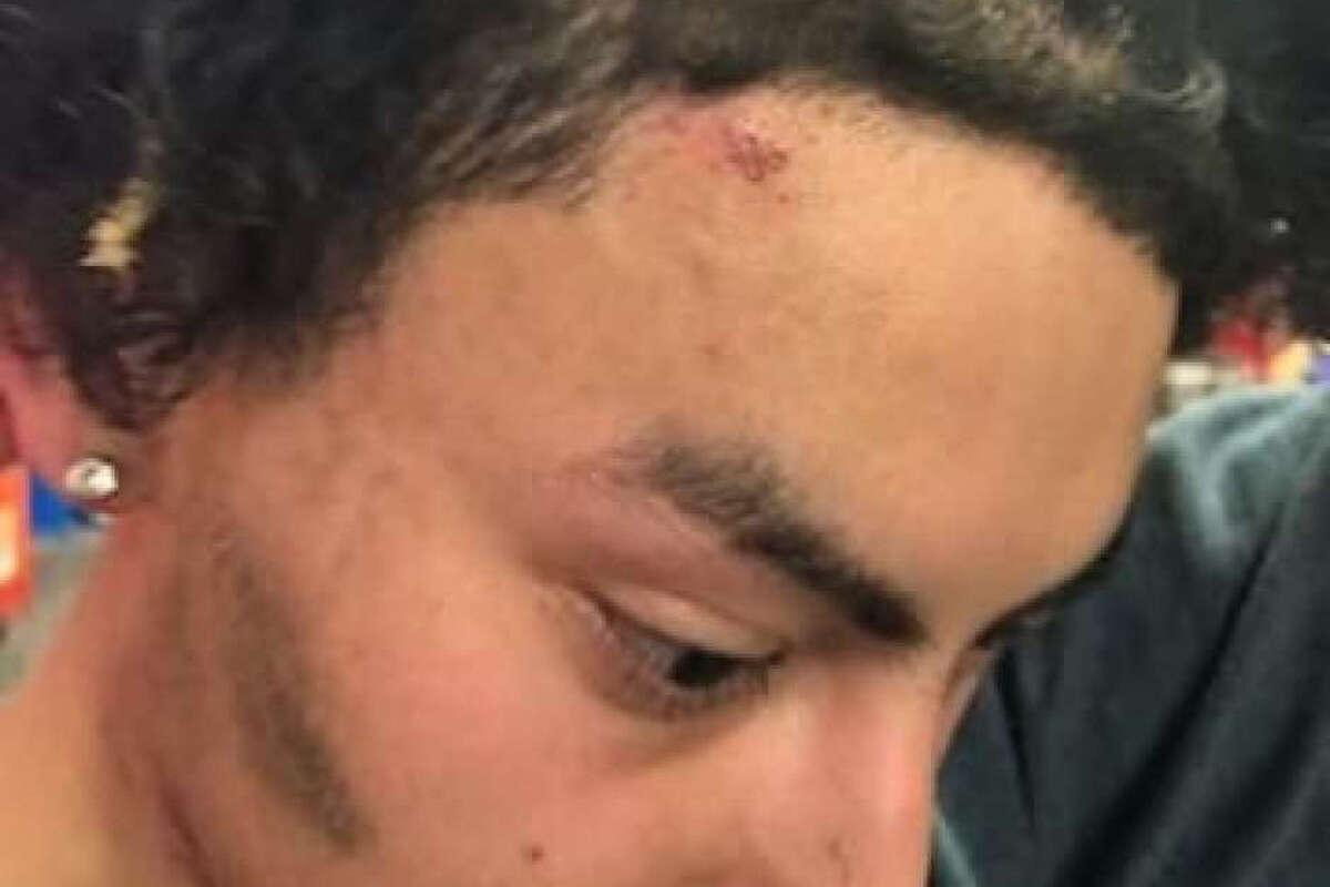 Pictures released by lawyers for Luis Montoya-Carranza show injuries sustained by the 19-year-old after he was pulled over and detained by San Pablo police on Feb. 28, 2020. A lawsuit claims police choked Montoya-Carranza after mistaking him for a shooting suspect.