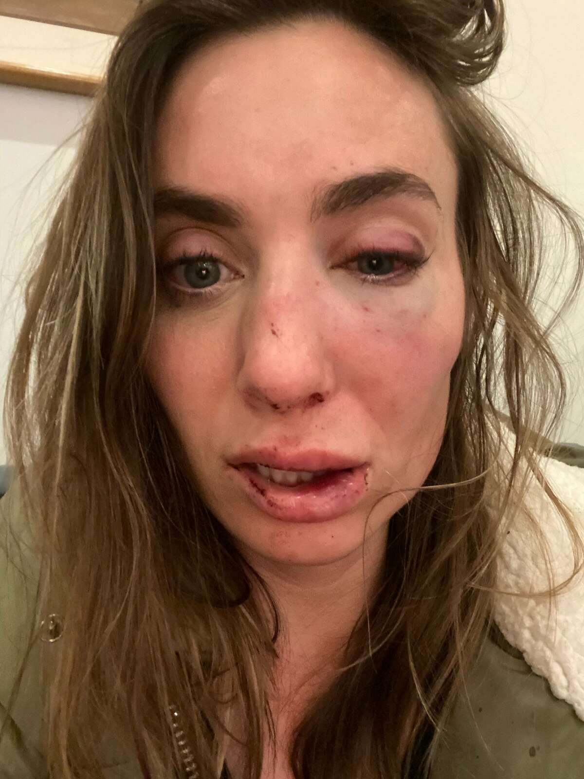 Sarah Vorhaus shows the injuries she sustained after she said she was robbed of her 5-month-old French bulldog at gunpoint in Russian Hill this week.