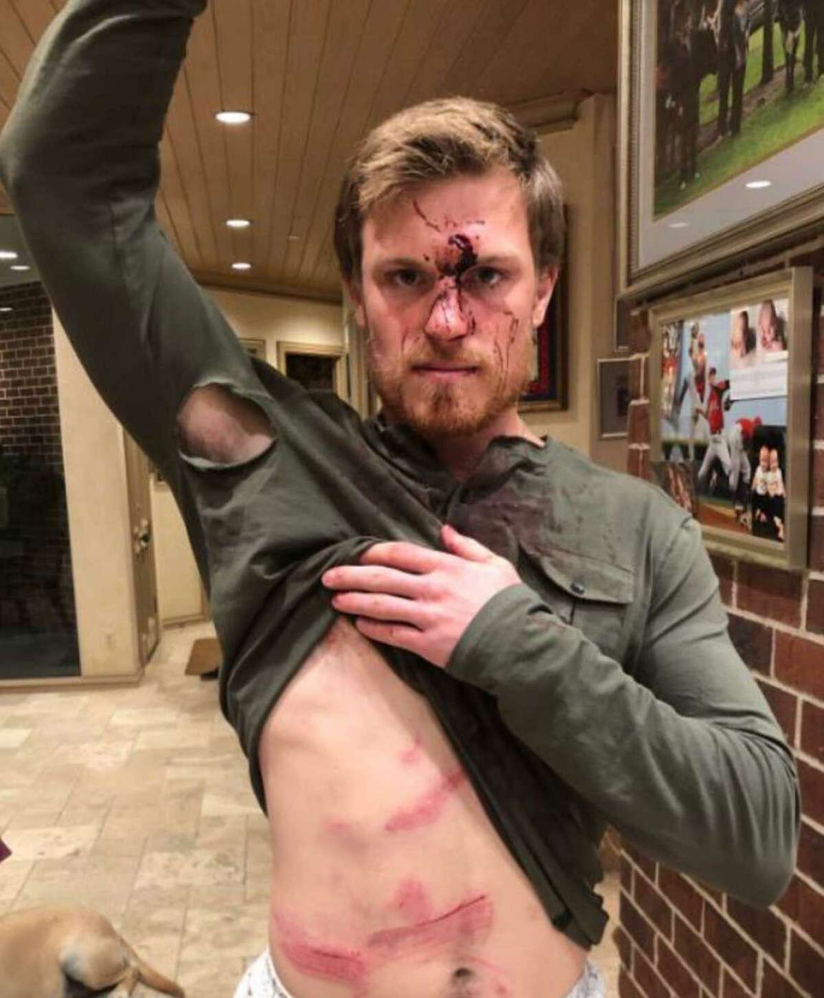 Conner Capel, 21, shows off injuries after a bouncer at Houston's Concrete Cowboy Bar allegedly assaulted him and 24-year-old Kacy Clemens, the son of former Houston Astros pitcher Roger Clemens, on Jan. 1, 2019.