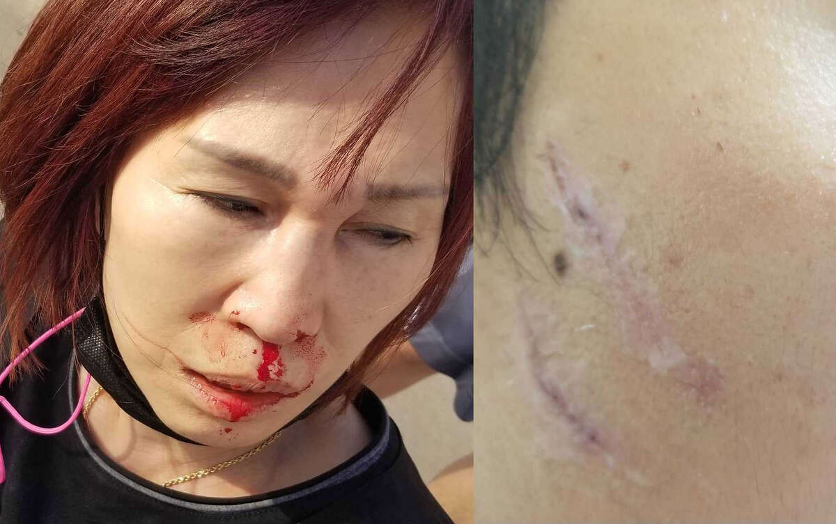 Photos show Jung Kim, left, and Sungjun Lee, right, with injuries after Jung was assaulted in the beauty supply store that she owns on March 17, 2021.