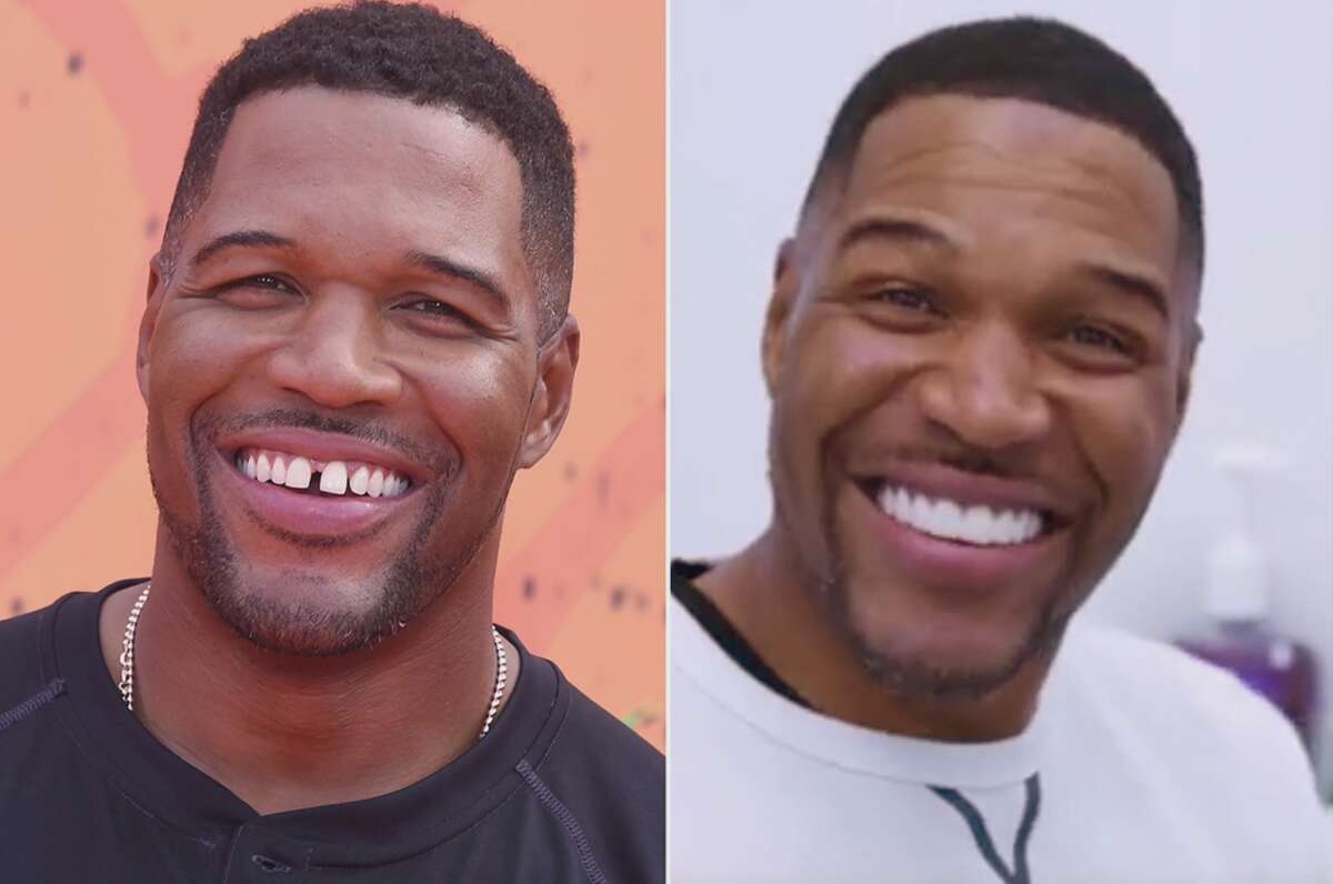 Michael Strahan gets his iconic tooth gap removed.