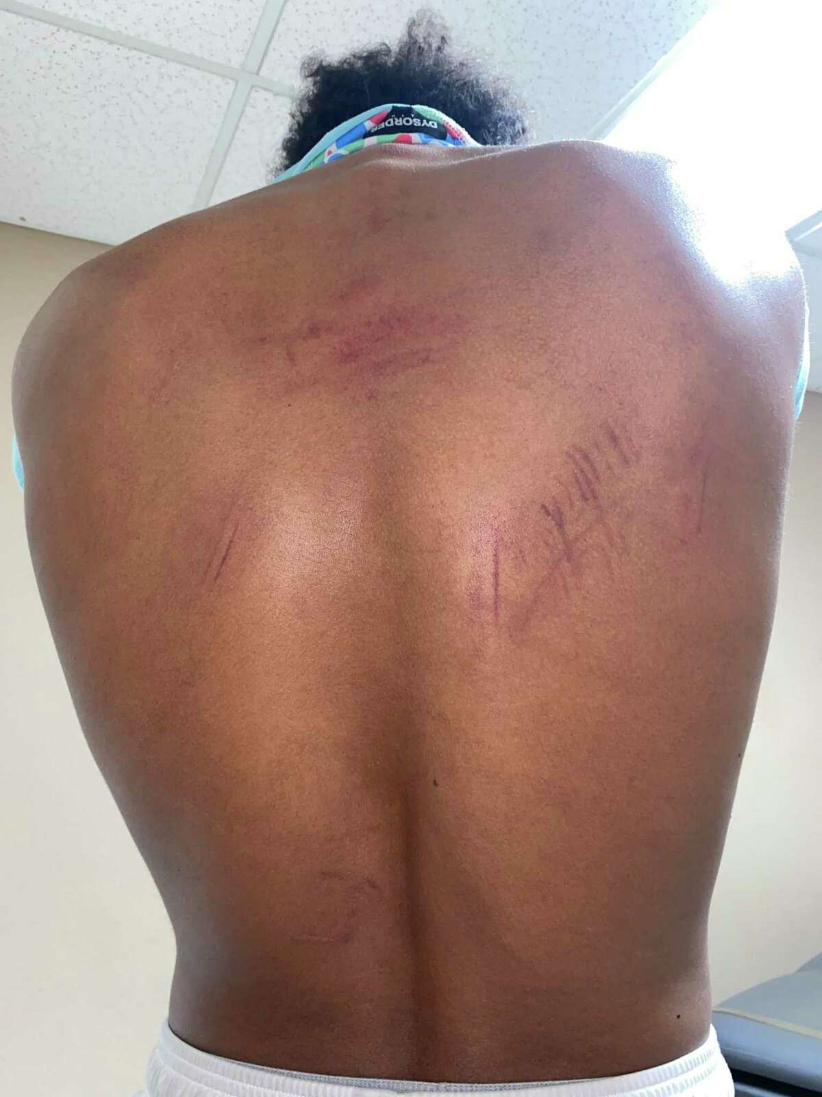 Devin Carter with bruises on his back after four Stockton police officers allegedly beat him during a traffic stop.