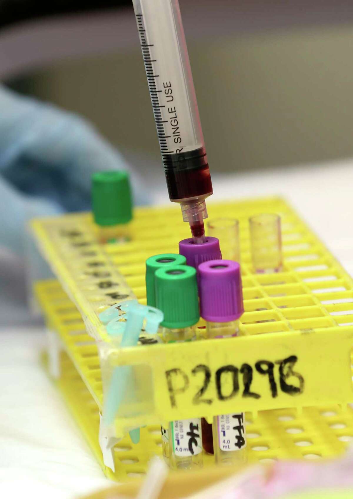 Melissa Mata, 55, goes through a series of blood glucose tests at the Texas Diabetes Institute. She agreed to participate in a San Antonio study of a new type of surgical procedure that's aiming to reduce the effects of Type 2 diabetes to improve treatment of the disease.