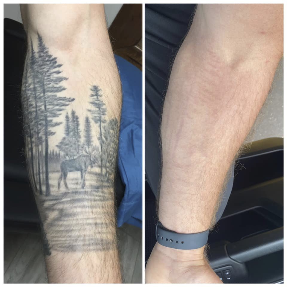 How can I remove my large tattoos safely