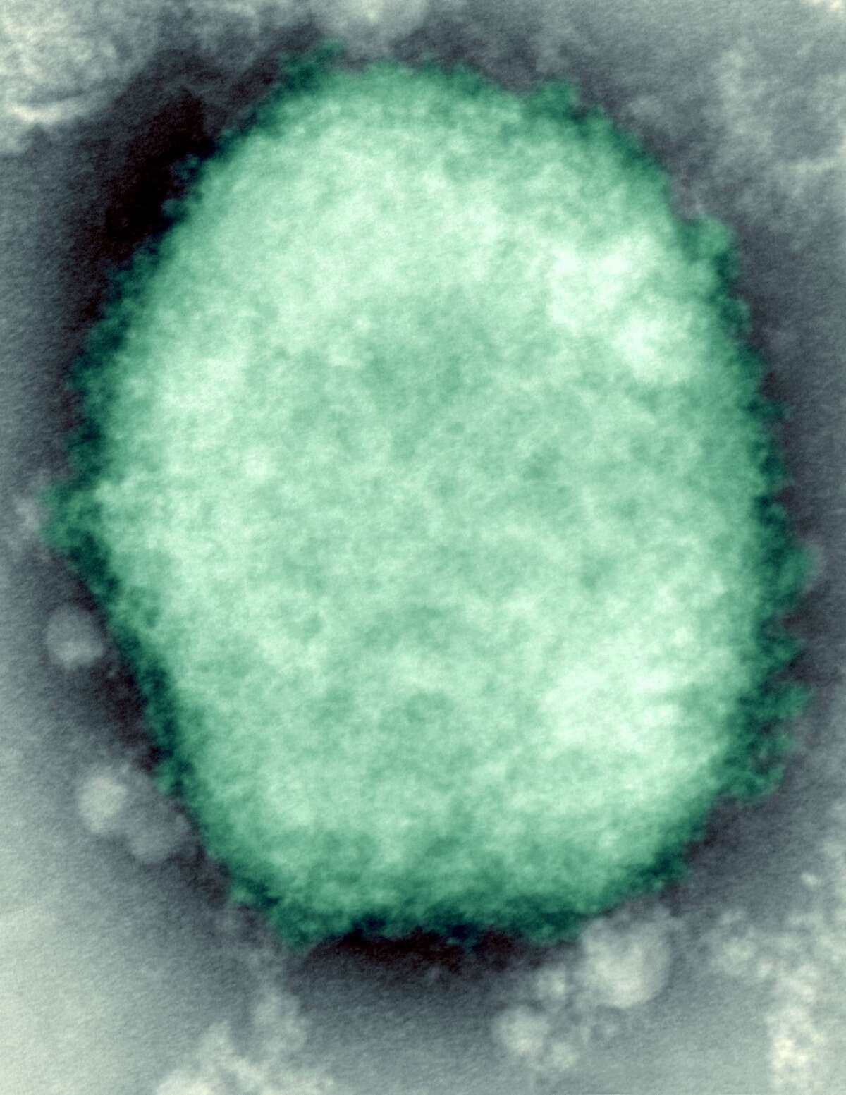 A photo of the monkeypox virus present in human vesicular fluid. (Photo By BSIP/UIG Via Getty Images)