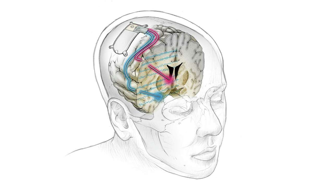 The implanted device connects to the amygdala to detect neural activity associated with symptoms of depression and another region where electrical stimulation is elicited in response.