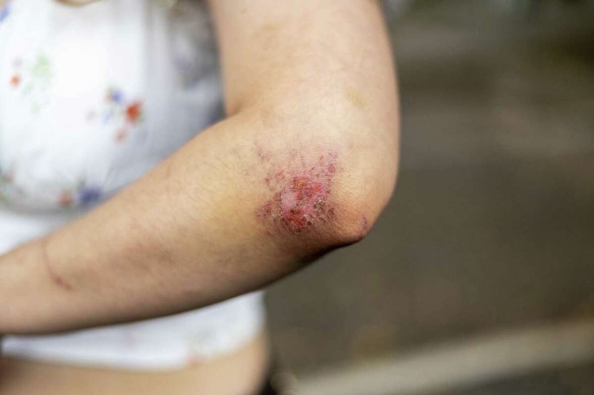 Cynthia Lira, who attended Astroworld, shows the results of her injuries near her home in Austin, Texas, on Nov. 10, 2021. Photo for The Washington Post by Sergio Flores