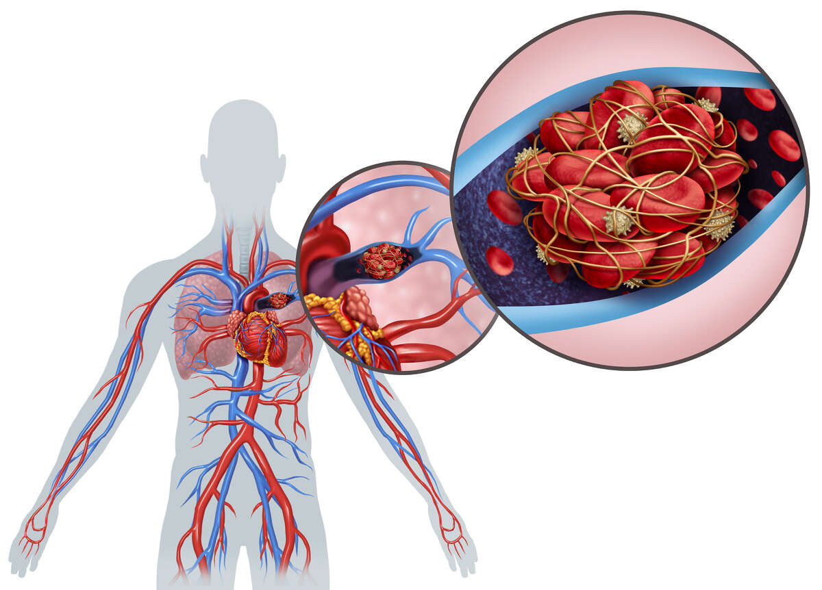 Pulmonary embolism is usually described as a blood clot that travels to the lungs. Blood clots in arteries, which carry blood from the heart, can cause heart attacks and strokes. But clots in veins are called deep vein thrombosis, or DVT. Those clots, often originating in the leg, can travel, or embolize, to the lungs.