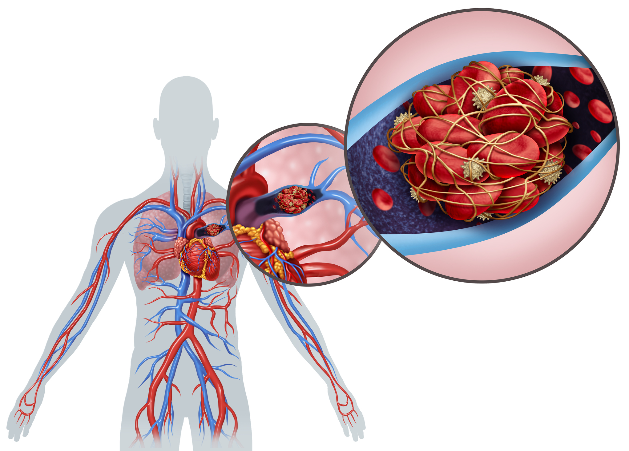 Pulmonary embolism common and can be deadly, but do you know the signs - Vimarsana News