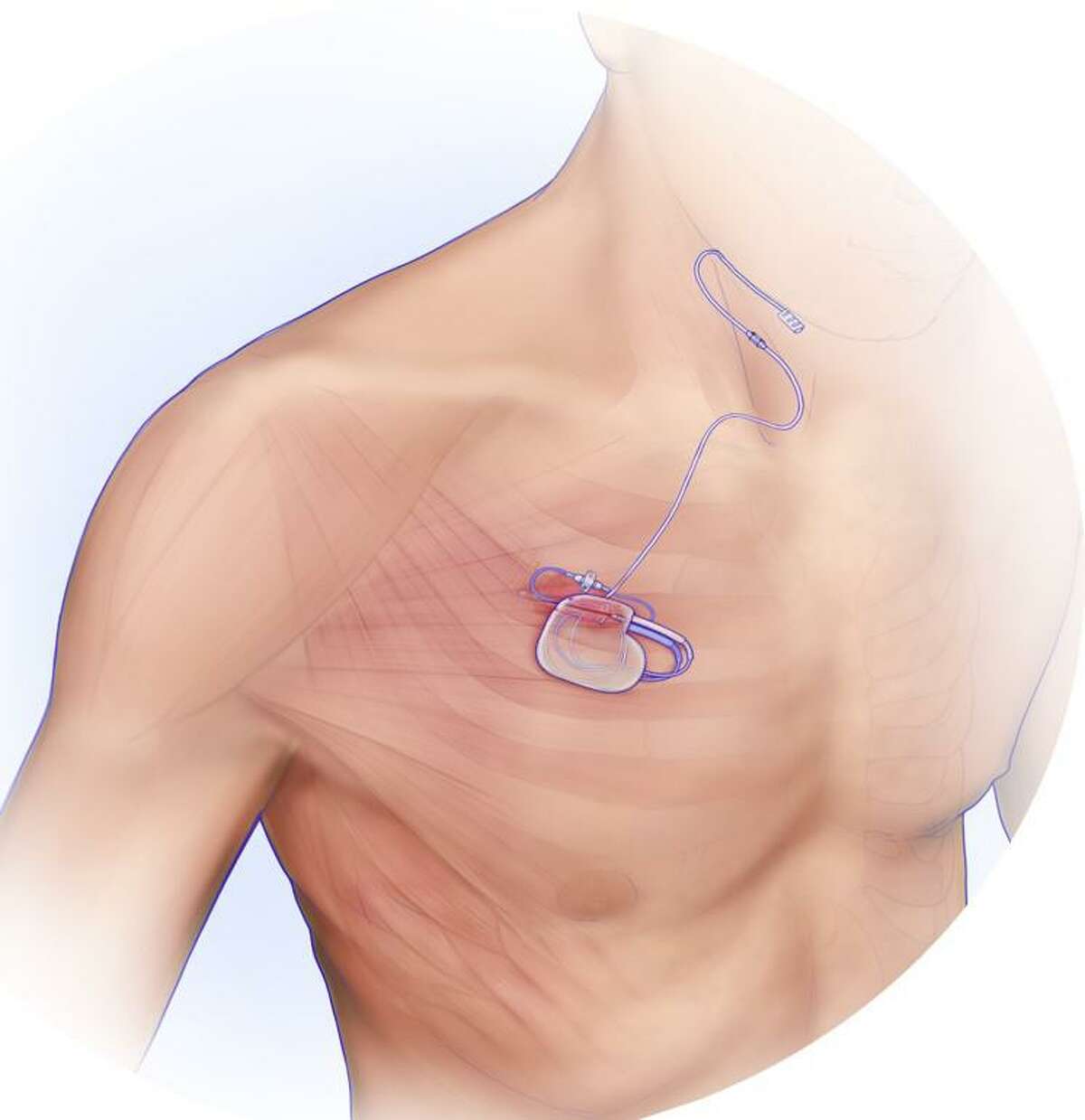 Illustration shows the location of the Inspire device and the leads that stimulate the hypoglossal nerve to prevent sleep apnea.