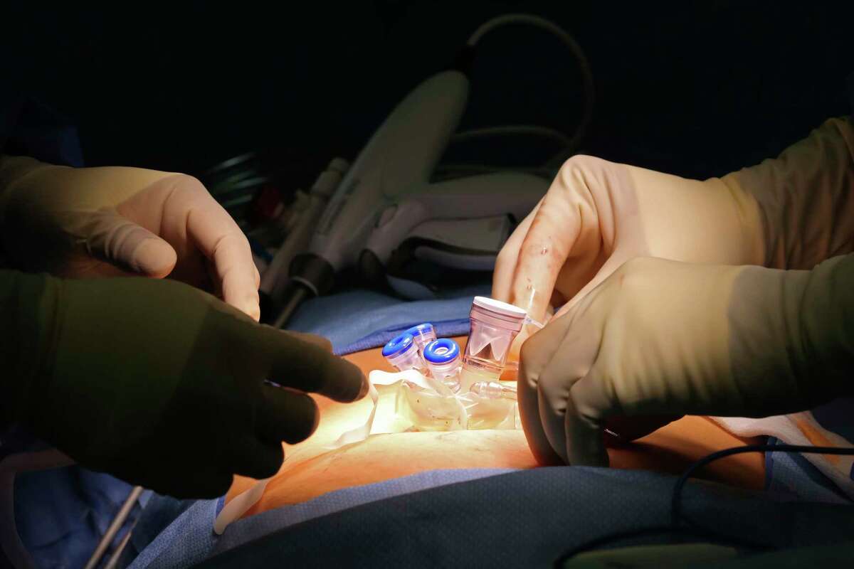 Dr. Ashwini Kumar, a surgeon at Texas Vista Medical Center, places a TriPort on 37-year-old Frances Cooper at the start of an appendectomy on Wednesday, Dec. 22, 2021. Kumar performed the appendectomy using single-site laparoscopic surgery. Single-site laparoscopy involves only one incision on a patient’s abdomen and facilitates faster recovery. With him is surgical assistant Moses Moreno.