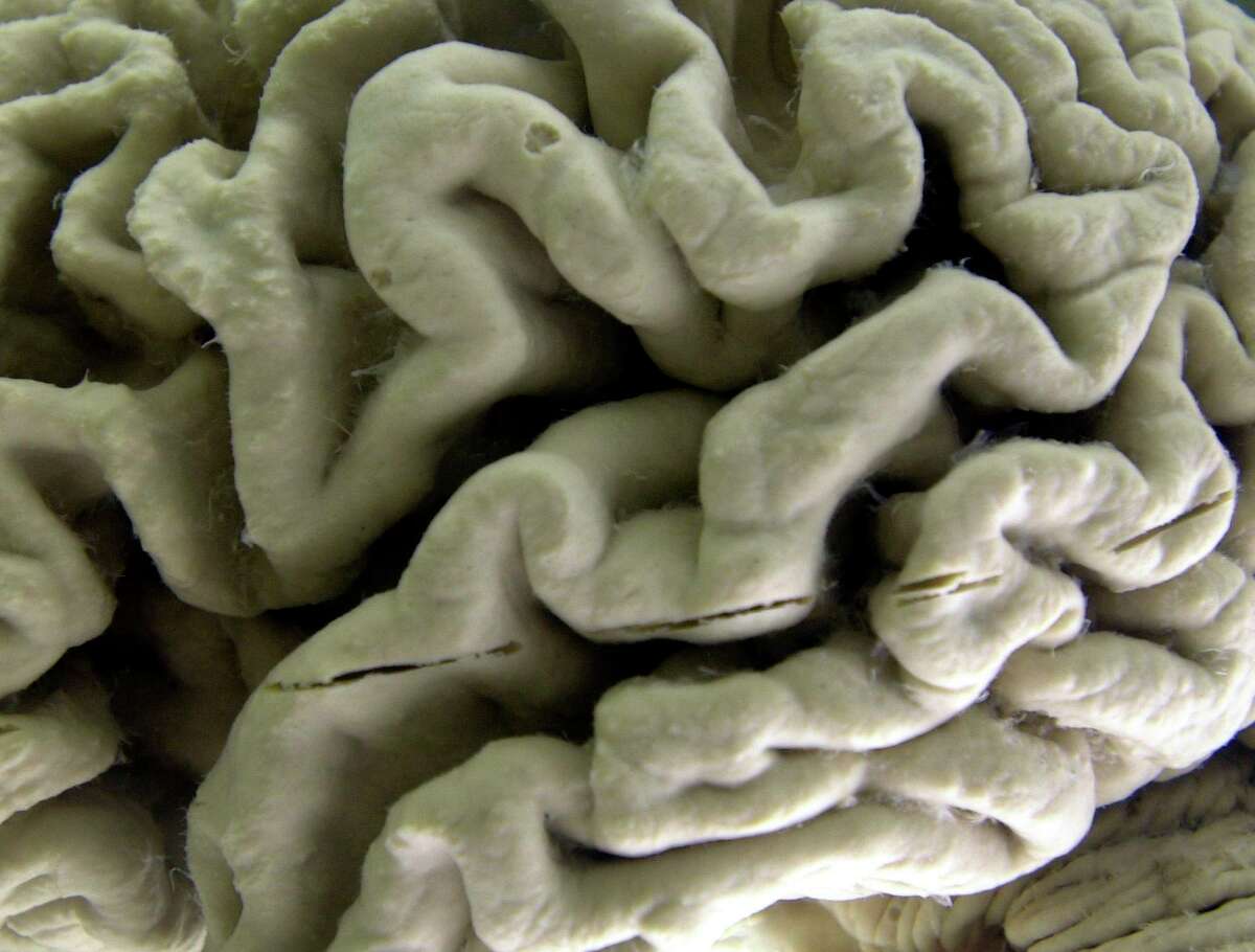A human brain with Alzheimer's disease.
