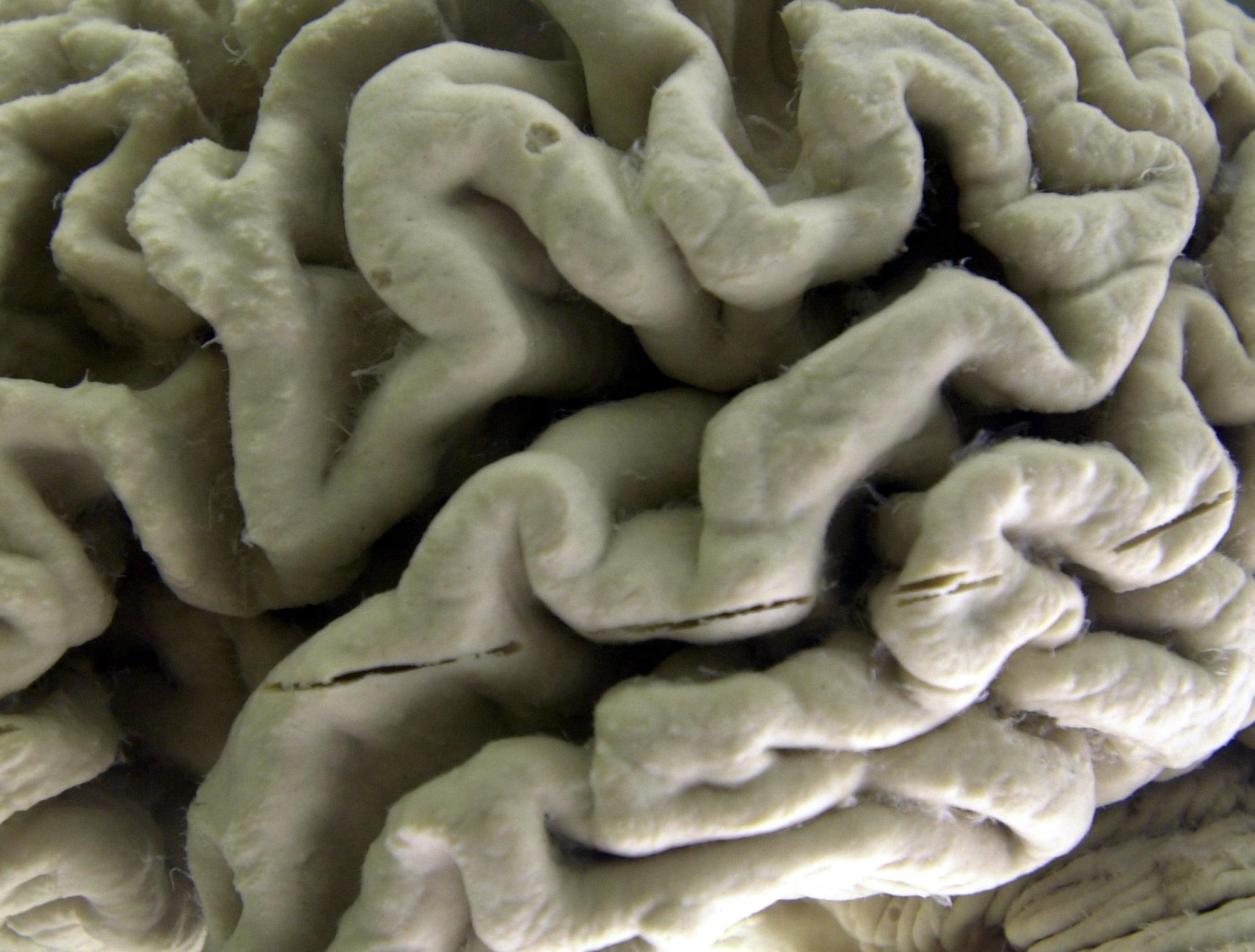 Opinion: We found that brains shrink in winter, thanks to our data - Vimarsana News