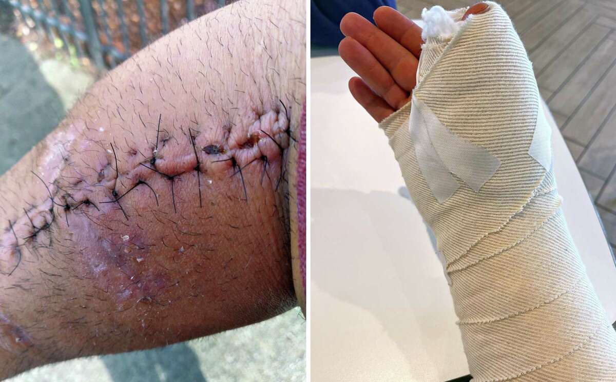 Ali Badr’s right arm, shown after surgery, was badly mauled after police stopped the Uber driver. Badr said the owner of the car he was renting had reported the vehicle stolen after he was late making payments.