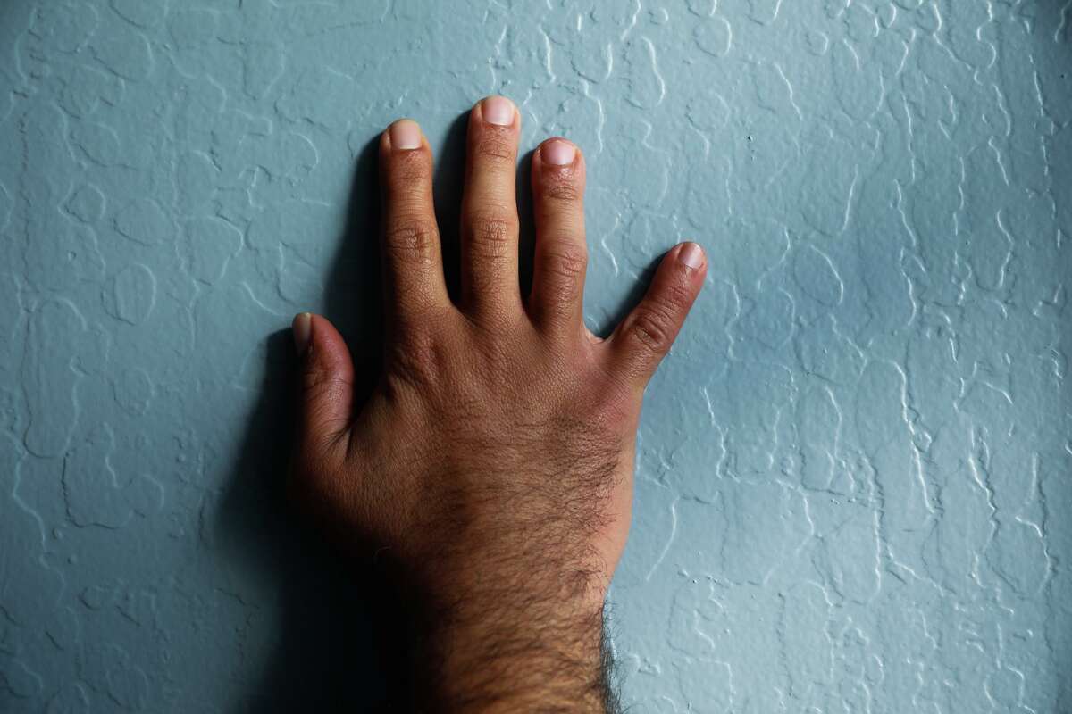 42岁的阿里·巴德尔展示了他右手受伤的戒指和小指。