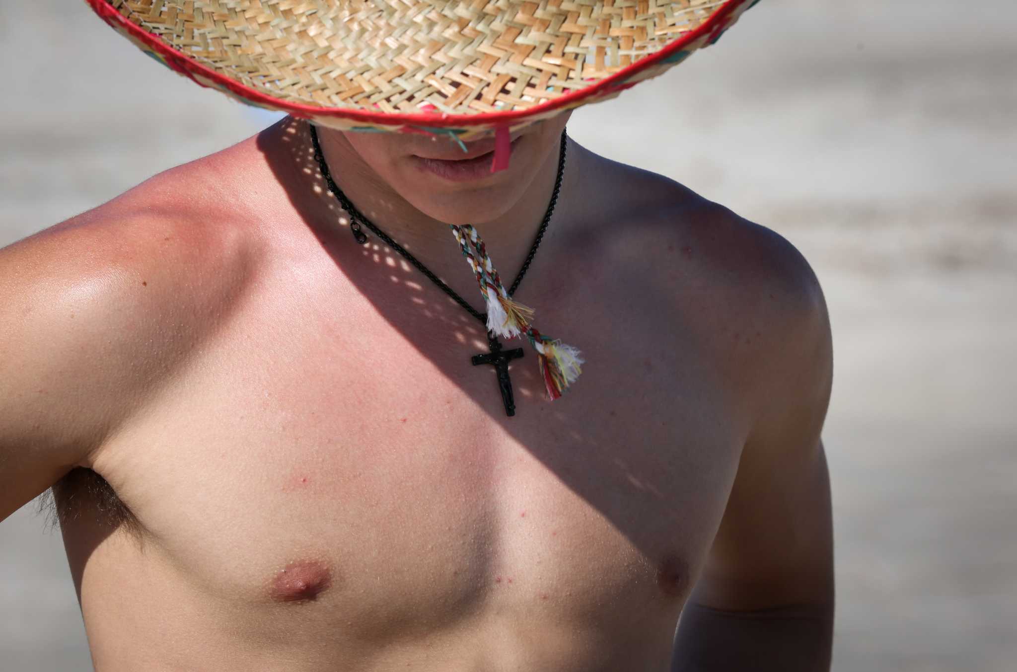 dangerous-texas-sunshine-what-you-need-to-know-about-sunburns