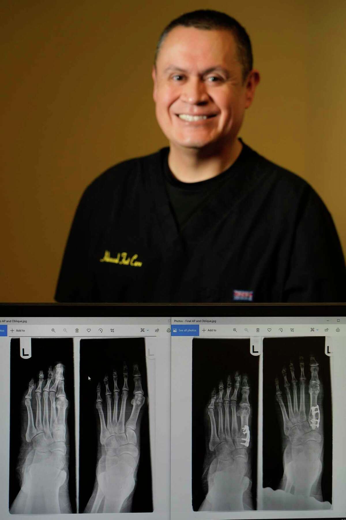 Dr. Fernando Fernandez, a podiatrist, is shown with before and after x-rays of patient’s feet Friday, March 4, 2022, in The Woodlands. The Lapiplasty 3D bunion correction uses two low-profile, anatomically-shaped titanium plates.