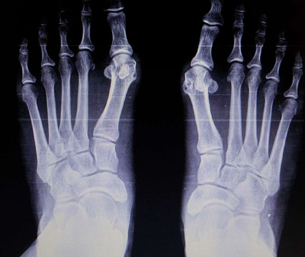 Got bunions? A Woodlands doctor offers an alternative to shaving them