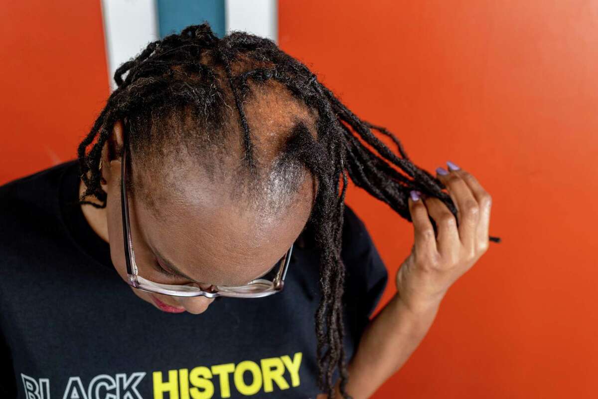Antoinette Lakey, 52, who was diagnosed with alopecia 15 years ago, shows the bald spot at the top of her head at home in San Antonio on Thursday. During Sunday’s Oscar telecast, comedian Chris Rock joked about actress Jada Pinkett Smith’s shaved head. Minutes later, her husband, actor Will Smith, slapped Rock for his comment about Pinkett Smith, who has alopecia. The incident inspired Lackey to go public and “out of the closet,” as she put it, about her own alopecia diagnosis.