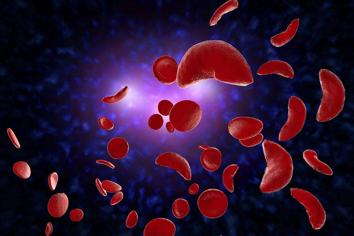 A  3D illustration of sickle cell anemia disease (SCD) blood cells