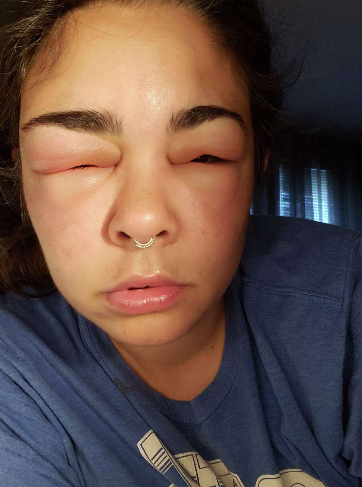 Beekeeper Melissa Marguy of Orange is pictured here about five hours after being stung by a bee on her forehead. Marguy has continued in the hobby/small business despite the pain and swelling. She now has an EpiPen close at hand and wears extra layers of protection.