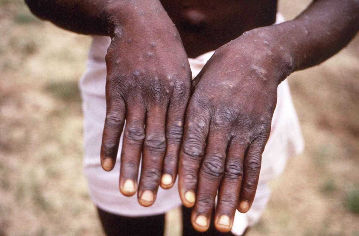 This 1997 image provided by the CDC during an investigation into an outbreak of monkeypox, which took place in the Democratic Republic of the Congo (DRC), formerly Zaire, and depicts the dorsal surfaces of the hands of a monkeypox case patient, who was displaying the appearance of the characteristic rash during its recuperative stage. As more cases of monkeypox are detected in Europe and North America in 2022, some scientists who have monitored numerous outbreaks in Africa say they are baffled by the unusual disease's spread in developed countries.