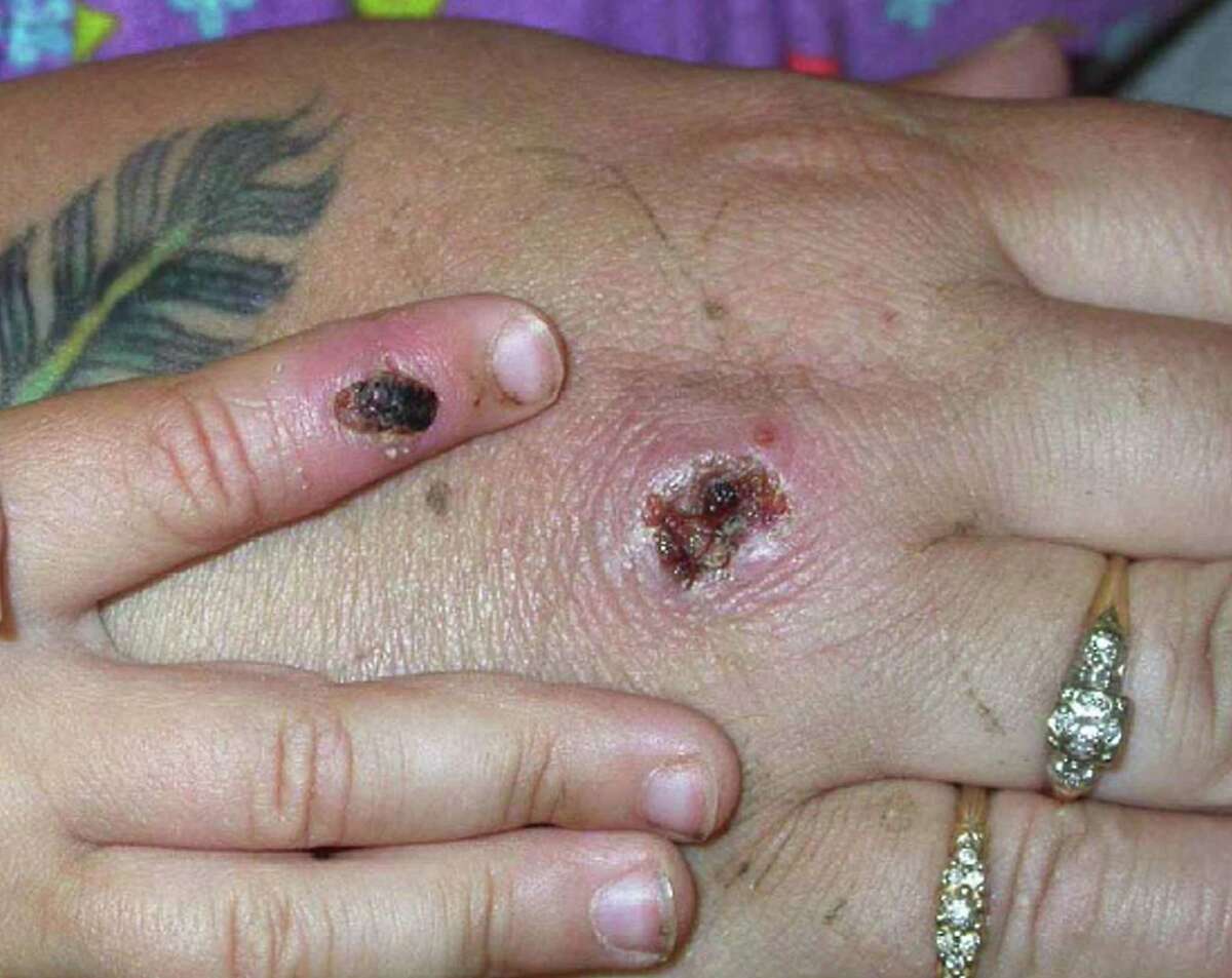 In this Centers for Disease Control and Prevention handout graphic, symptoms of one of the first known cases of the monkeypox virus are shown on a patient's hand on June 5, 2003. New York City is awaiting a CDC ruling if it has its first case of monkeypox virus in May 2022.