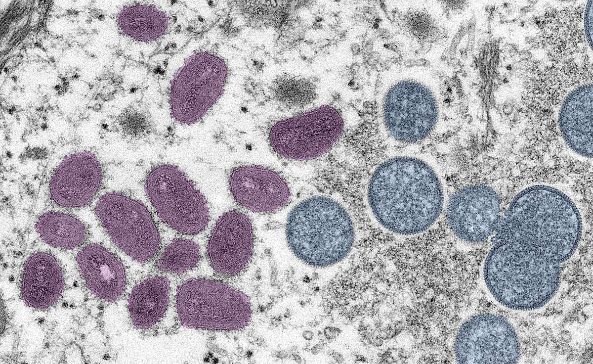 Digitally-colorized electron microscopic (EM) image depicting a monkeypox virion (virus particle), obtained from a clinical sample associated with a 2003 prairie dog outbreak, published June 6, 2022. Albany County Executive Dan McCoy said the county's first infected person has a history of out-of-state travel and the county does not believe the disease was contracted in the county. Courtesy CDC/Goldsmith at al. (Photo via Smith Collection/Gado/Getty Images)