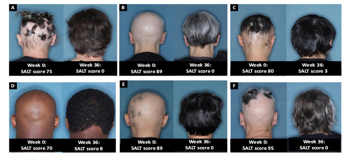 Yale University doctors at the heart of promoting new alopecia areata drugs are seeing proof with FDA approval