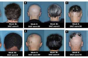 Doc at center of new alopecia areata treatment sees vindication