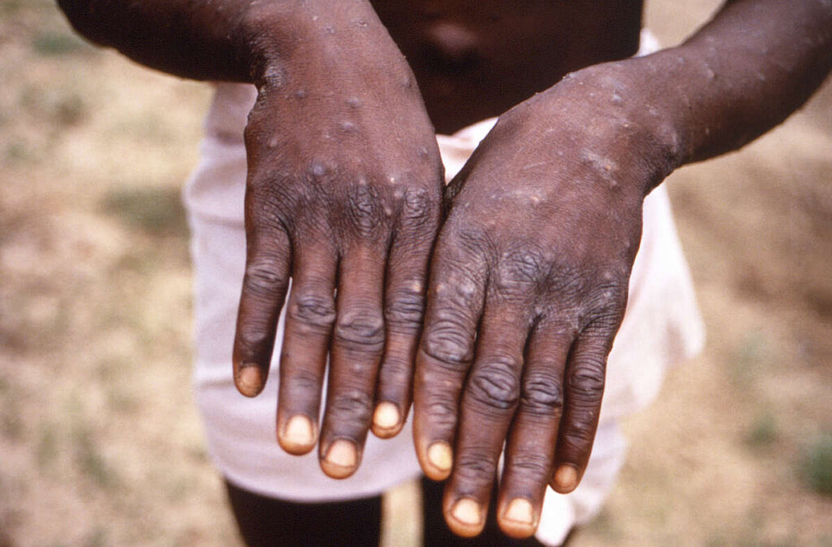 This 1997 image provided by the CDC during an investigation into an outbreak of monkeypox, which took place in the Democratic Republic of the Congo (DRC), formerly Zaire, and depicts the dorsal surfaces of the hands of a monkeypox case patient, who was displaying the appearance of the characteristic rash during its recuperative stage. The World Health Organization is creating a new vaccine-sharing mechanism to stop the spiraling outbreak of monkeypox in more than 30 countries beyond Africa. (CDC via AP, File)