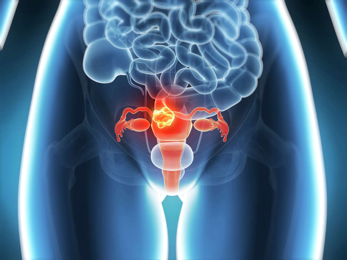 Cancer of the uterus, computer illustration.