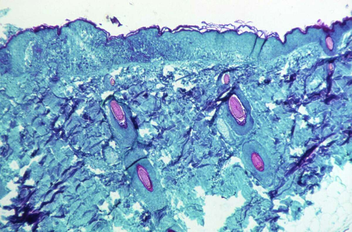 Monkeypox in the Bay Area: Here’s what you need to know. Microscope image of skin tissue from lesion on a monkey infected with the monkeypox virus, 1968. Courtesy CDC. (Photo via Smith Collection/Gado/Getty Images)