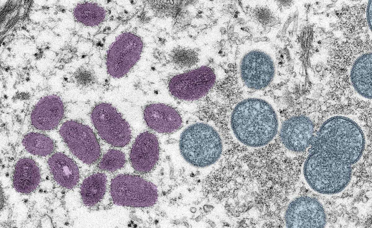 A digitally colorized electron microscopic image depicting a monkeypox virion (virus particle) obtained from a clinical sample associated with a 2003 prairie dog outbreak. A human outbreak is at a “critical stage” in the Bay Area, but there are precautions and preventive steps people can take against catching the virus.