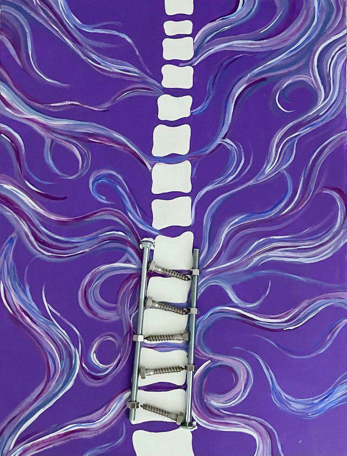 Ava Lee’s art in her exhibit “43 Degrees” explores her journey from scoliosis diagnosis to eventual surgery.