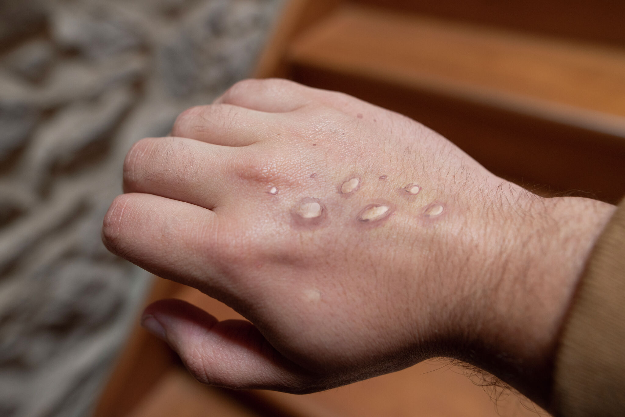 Probable case of monkeypox being investigated in St. Clair County, Illinois, located southeast of St. Louis, with the county seat of Belleville, Illinois - Vimarsana News