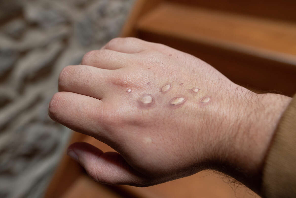 Monkey pox vesicles in a hand