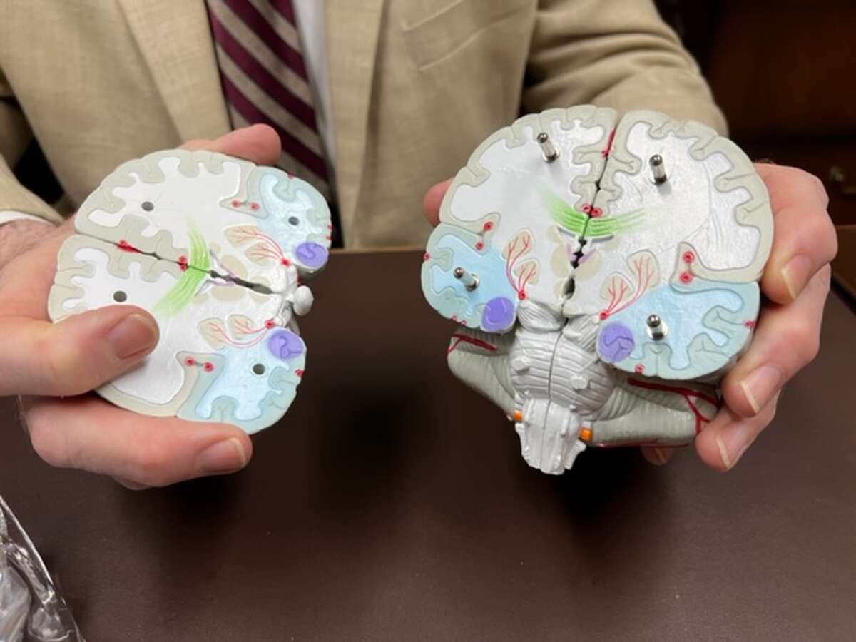 Dr. Richard Holub shows the model of the brain, with blue areas in the hippocampus area of the brain affected by amyloid plaques and tau protein tangles that accumulate in neurons and block synapses.