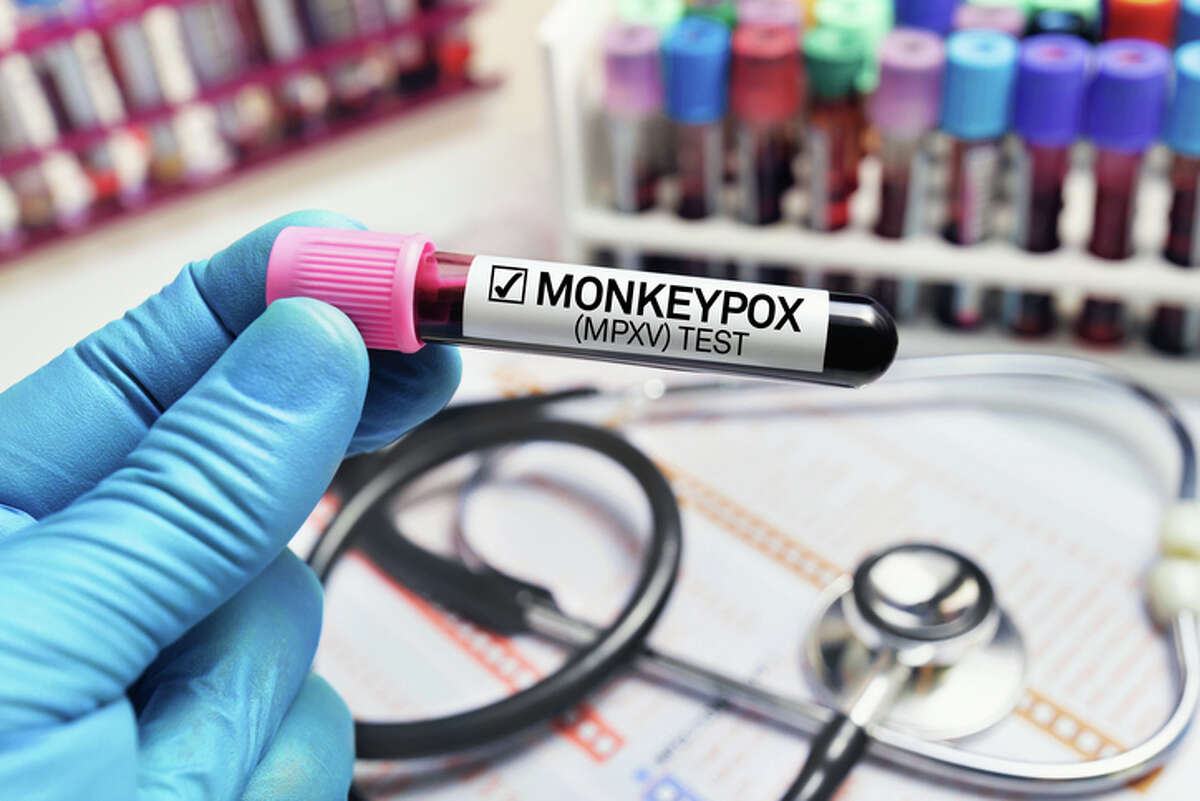 Health officials have identified a single probable case of monkeypox in Sangamon County.