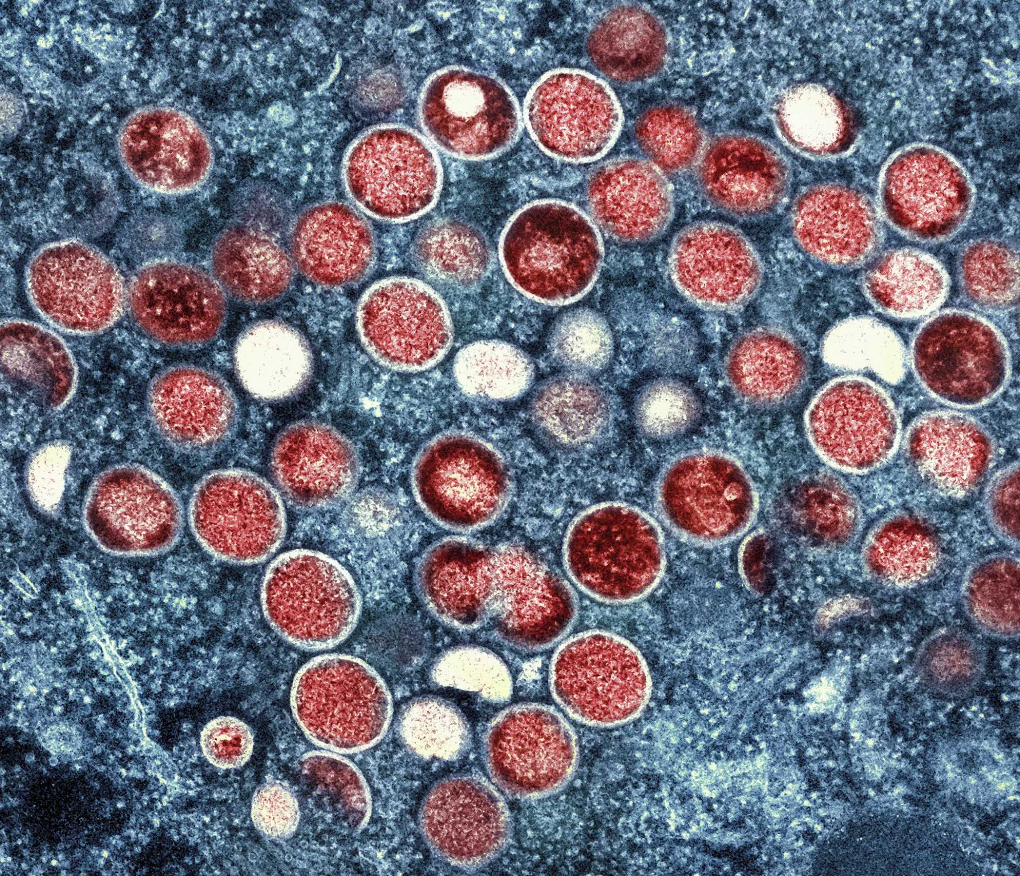 Monkeypox cases increasing in San Antonio, risk remains low - Vimarsana News