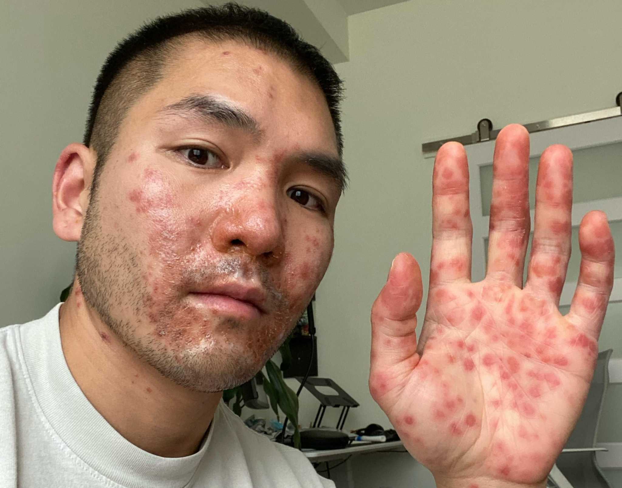 A Bay Area man’s monkeypox diagnosis was ‘painful and terrifying’