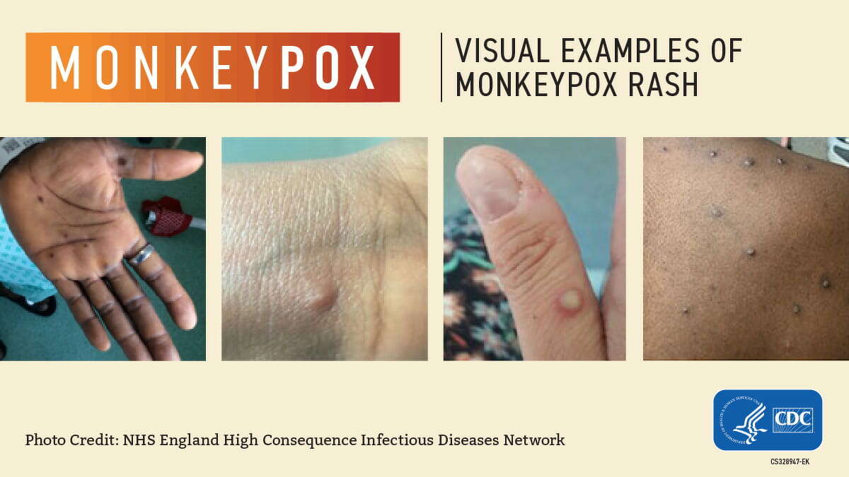 Monkeypox is contagious when a rash is present and up until scabs have fallen off. Symptoms generally appear one to two weeks after exposure and infection, and the rash often lasts two to four weeks. For more information, visit the State of Michigan dashboard at michigan.gov/mpv