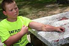 Ryland Ward shows a gunshot wound on his left arm on June 8, 2022. Ward was 5-years-old when he was shot multiple times after a gunman entered First Baptist Church in Sutherland Springs, Texas, killing 26 people with an AR-15 style weapon in 2017.