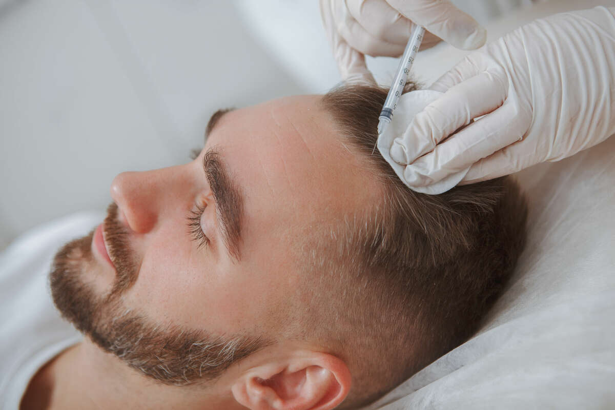 Refreshed Medical Aesthetics in Hartford treats patients who experience androgenic alopecia and alopecia areata, two different types of hair loss.