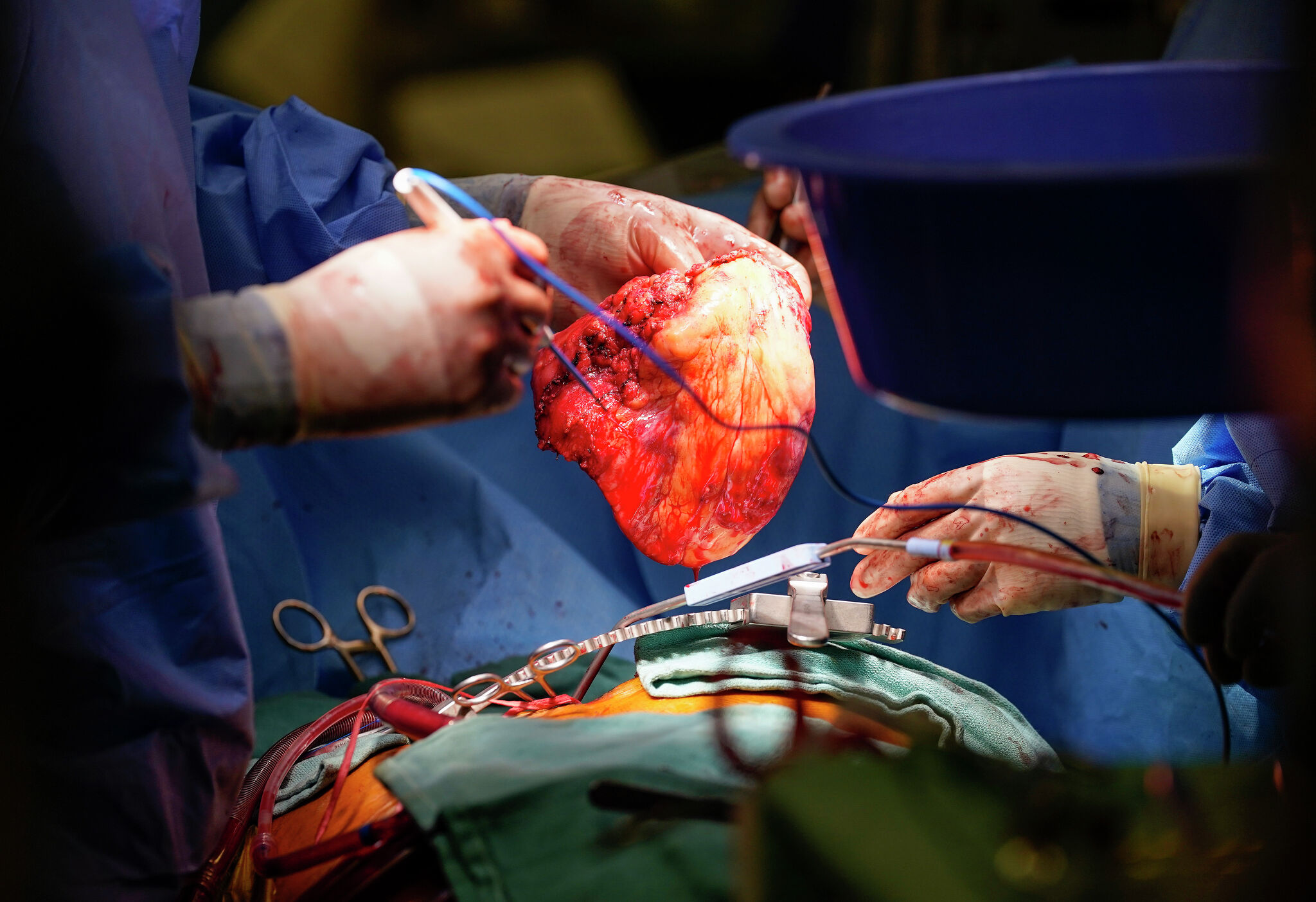 How groundbreaking tech could revolutionize heart transplants in Houston