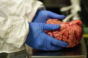 Inside a Houston brain bank, researchers explore drug addiction
