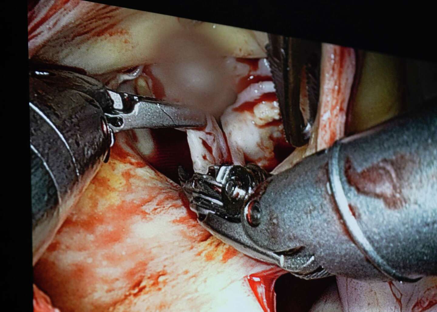 As Houston heart surgeons tap robot assistance, questions remain