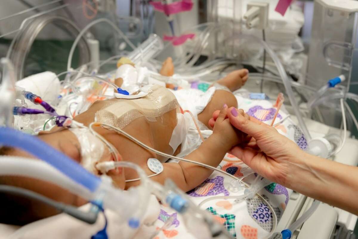 Texas conjoined twins separated after 'historic surgery'