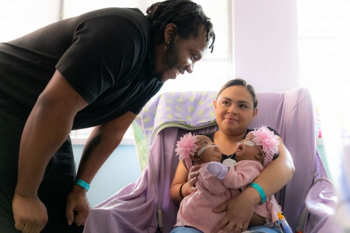 Texas conjoined twins separated after 'historic surgery'