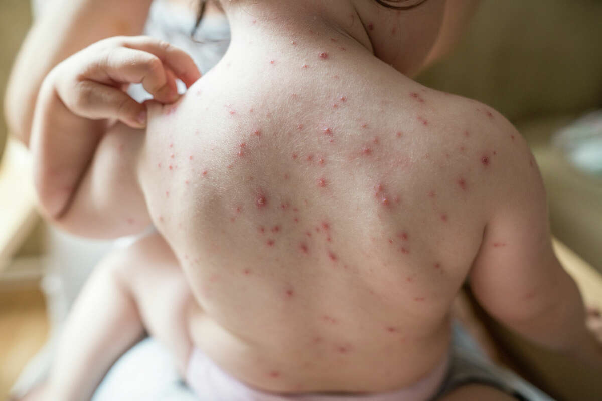 A case of chickenpox reported in the Pikeland school district in Pittsfield, while not alarming, is a cause for concern for students who might not be vaccinated.